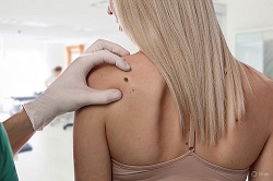 Кератома кожи: основные особенности и как отличить от родинок и меланомы